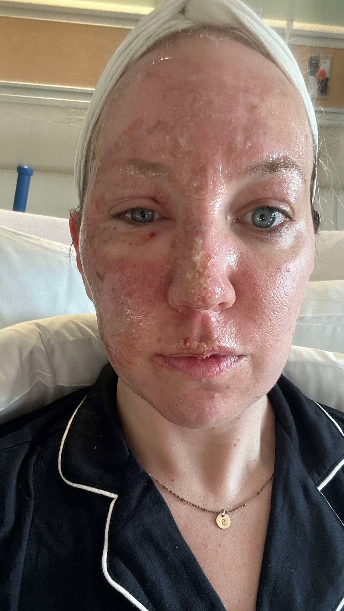 Go Fund Me page set up for Watrous burn victim - DiscoverHumboldt.com